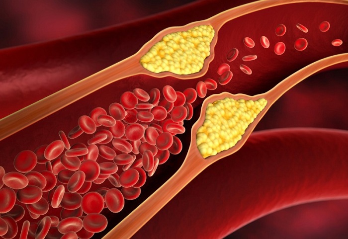 Nanoparticle Technology for Cardiovascular disease