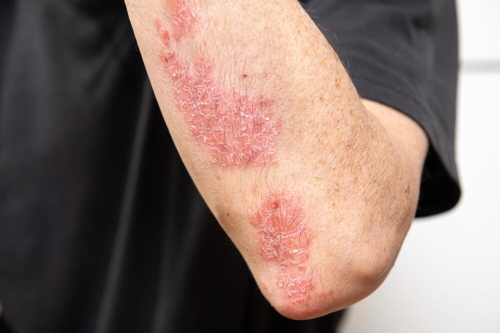 Sotyktu's 5-Year Data Support Its Long-Term Efficacy for Plaque Psoriasis.