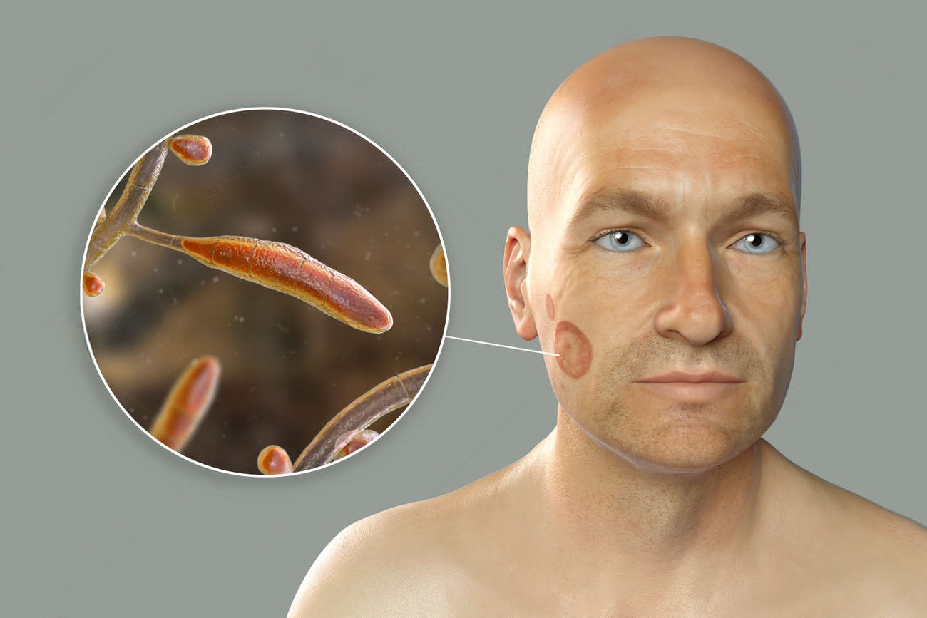 The Emerging Risk of Fungal Infections: A Call for Immediate Action.