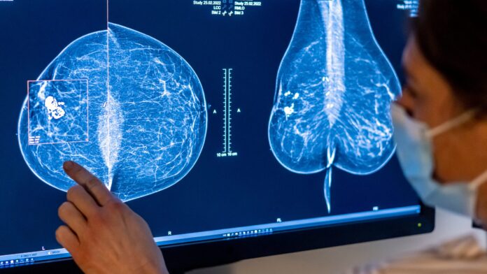 Clarity Mammography Risk Score